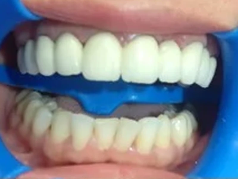 Vue frontale de la dentition après traitement